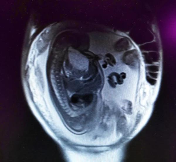 Baby in de baarmoeder op MRI scan van de buik — Stockfoto