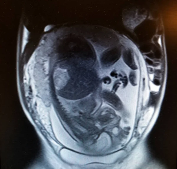 Baba a méhben Mri Scan a has — Stock Fotó