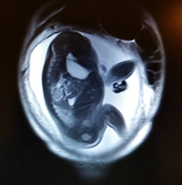 Baby in de baarmoeder op MRI scan van de buik — Stockfoto