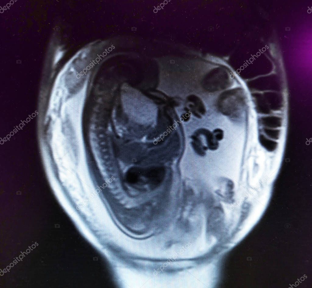 Baby in Womb on MRI Scan of Abdomen — Stock Photo