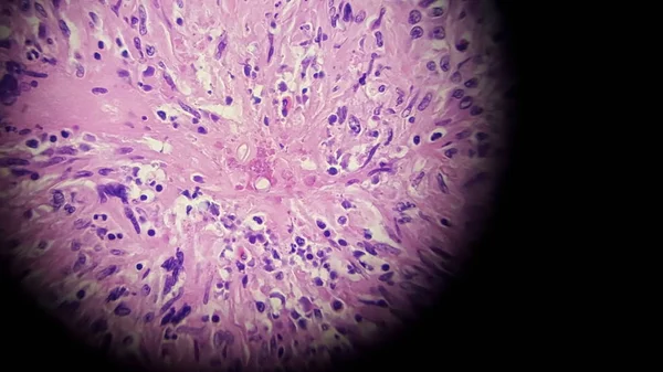 Basidiobolus fungal hyphae in colon biopsy specimen — ストック写真