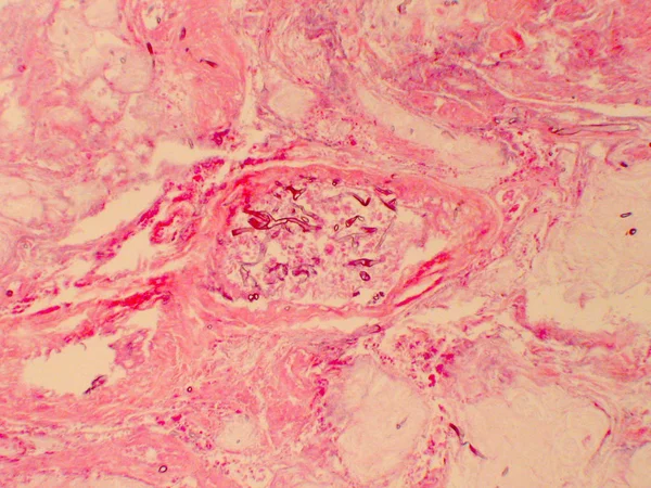 Klaster apophysomyces hyphae w materiale do biopsji tkanek — Zdjęcie stockowe