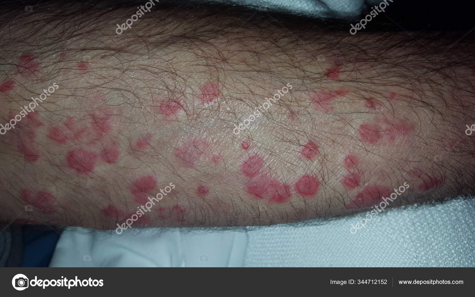 Erythema Multiforme Annular Erythematous Targetoid Skin Lesions Stock