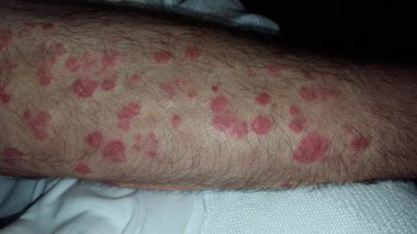Erythema multiforme annular erythematous targetoid skin lesions