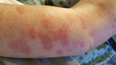 Erythema multiforme annular erythematous targetoid skin lesions