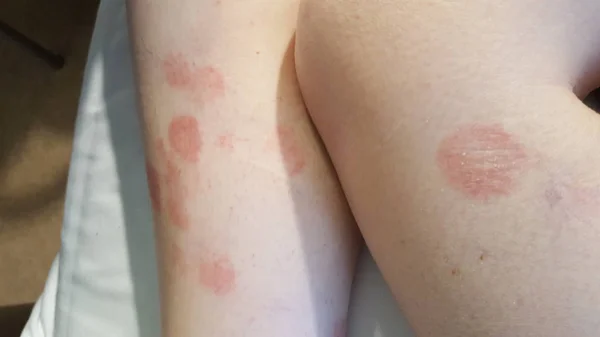 Erythema multiforme annulární erytematózní cílené kožní léze — Stock fotografie