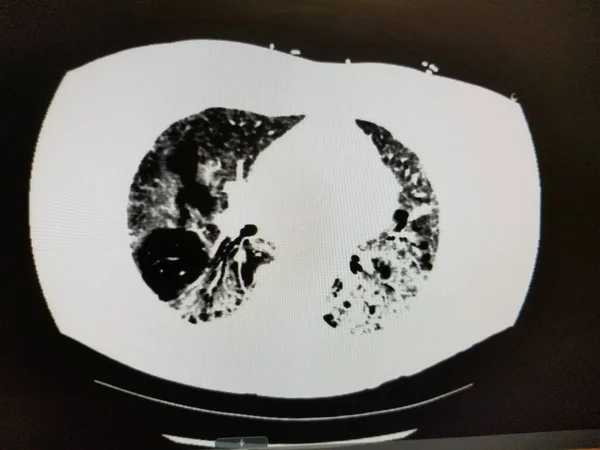 COVID-19 CT Escaneo del pecho en paciente con enfisema — Foto de Stock