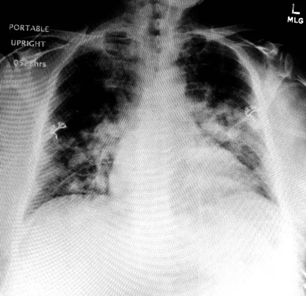 COVID-19 πνευμονία Εικόνα CXR με γραμμές παρεμβολής — Φωτογραφία Αρχείου