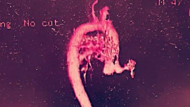 Tomografi ve döndürme ile aort kavisi arteriogrram