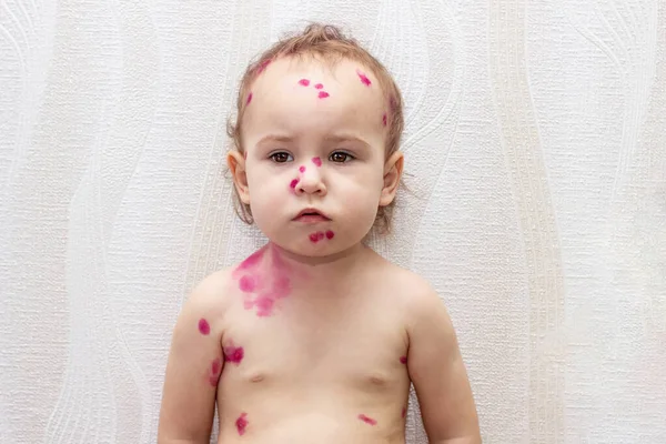 Portrait of a charming baby with red spots of chickenpox on a light background of wallpaper at home. Child with chickenpox rash on face and body, natural photo. copy space, medicine, vaccine.