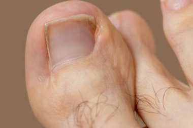 Ingrown toenail with scars of an operation and toe surgery shows the need of medical pedicure in form of an ugly European foot with hairs on the toe and ugly nails in macro close-up view clipart