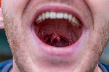 Geniş ağzı açık ve boğazında çift küvül şeklinde garip bir anormallik olan bir adam, erkek uvula ve tıbbi anatomik notlarda nadir görülen bir anormallik ve komik anatomi gösteriyor.