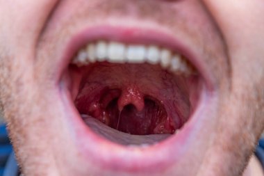 Geniş ağzı açık ve boğazında çift küvül şeklinde garip bir anormallik olan bir adam, erkek uvula ve tıbbi anatomik notlarda nadir görülen bir anormallik ve komik anatomi gösteriyor.