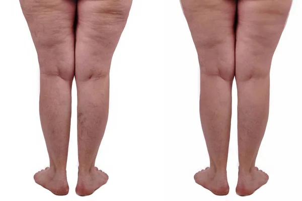 Female legs with cellulite before and after treatment. Isolated — Stock Photo, Image