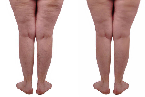 female legs with cellulite before and after treatment. Isolated 