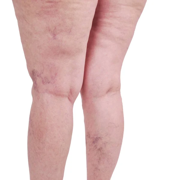 Female legs with varicose veins and leg spiders. The concept of human health and illness. White background. Vascular diseases, problems of varicose veins.