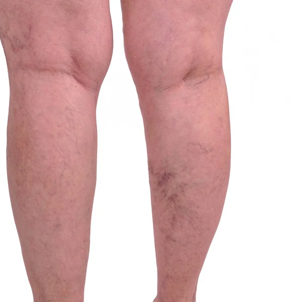 Weibliche Beine Mit Krampfadern Und Beinspinnen Das Konzept Der Menschlichen — Stockfoto