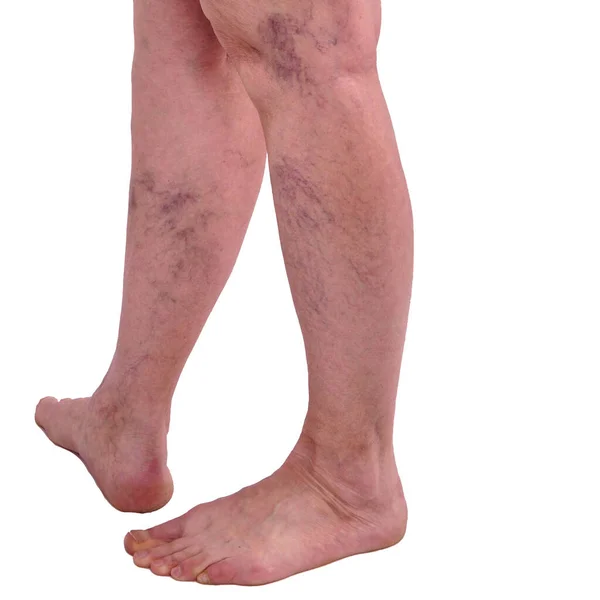 Kobiece Nogi Żylakami Pająkami Nóg Koncepcja Ludzkiego Zdrowia Chorób Białe — Zdjęcie stockowe