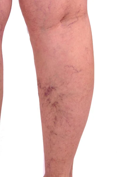 Female Legs Varicose Veins Leg Spiders Concept Human Health Illness — Stock Photo, Image