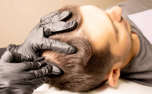 Male trichopigmentation service. Young man laying on the back on the esthetician table. Master hands in a black gloves holding the permanent makeup machine with the needle and touching mans hair. — Stock Photo, Image