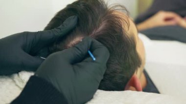 Yüksek kalite yakın çekim 4K yavaş çekim videosu. Estetisyen saç tedavisiyle koltukta yatan bir adam. Erkek tricopigmentasyon servisi. Kafa derisi mikro pigmentasyon tedavisi. Trikopigmentasyon prosedürü.
