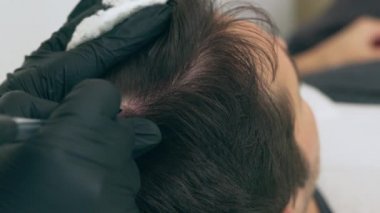 Yüksek kalite yakın çekim 4K yavaş çekim videosu. Estetisyen saç tedavisiyle koltukta yatan bir adam. Erkek tricopigmentasyon servisi. Kafa derisi mikro pigmentasyon tedavisi. Trikopigmentasyon prosedürü.