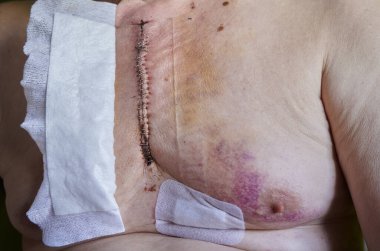 Ameliyatta göğüsteki yarık göğüs kemiğindeki yırtığı gösteriyor.