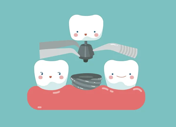L'implant dentaire, les dents et le concept dentaire — Image vectorielle