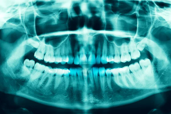 Woman x-ray of the teeth wisdom teeth horizontal pozition problem dentistry medicine. Panoramic image of teeth. 3d render