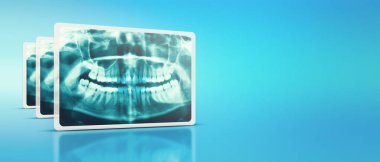 Woman x-ray of the teeth wisdom teeth horizontal pozition problem dentistry medicine. Panoramic image of teeth. 3d render clipart