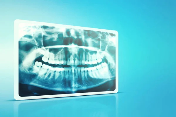 Woman x-ray of the teeth wisdom teeth horizontal pozition problem dentistry medicine. Panoramic image of teeth. 3d render