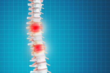 Realistic skeletal human spine and vertebral column or intervertebral discs on a dark background. Lower back pain. Vertebral column in glowing highlight as a medical health care concept. clipart