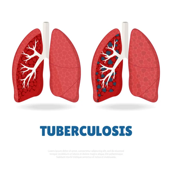 Tuberculose — Stockvector
