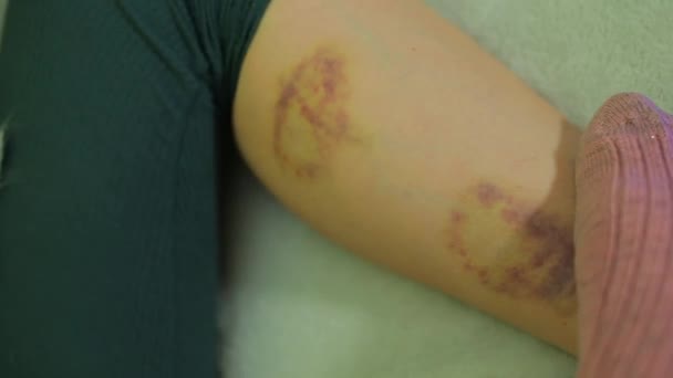 Gros plan d'une ecchymose sur une jambe de fille après une violence conjugale . — Video