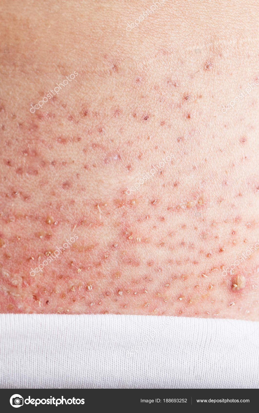 Three days after needle epilation on bikini line. — Foto de stock