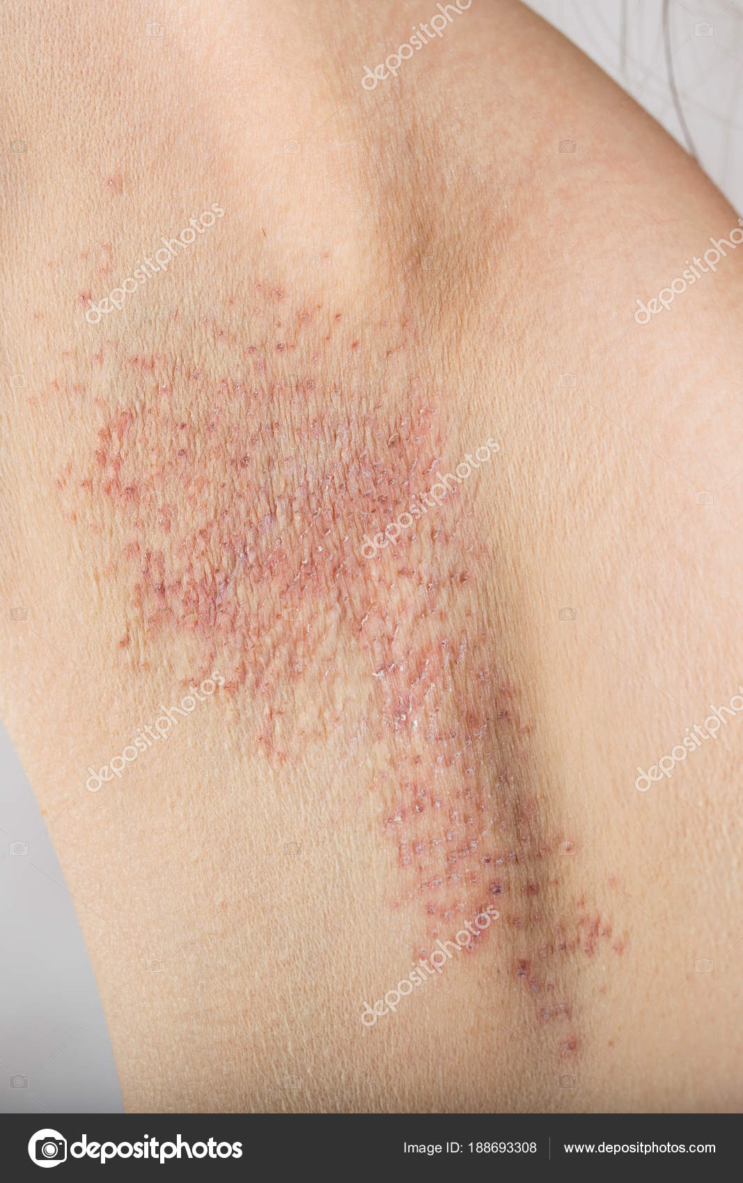 Drei Tage nach Nadelepilation in der Achselhöhle. — Stockfoto