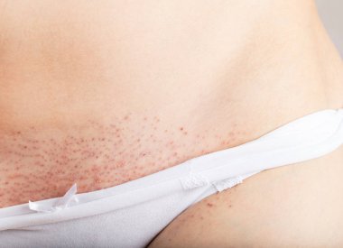 Üç gün sonra iğne epilasyon bikini satırındaki. 