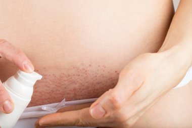 Üç gün sonra iğne epilasyon bikini satırındaki. 
