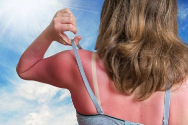 Sunburn concept. Young woman with red sunburned skin on her back. clipart