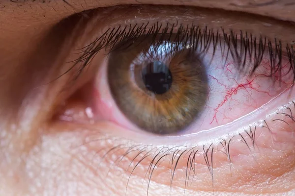 Close-up view on red injured or irritated eye. — Stock Photo, Image