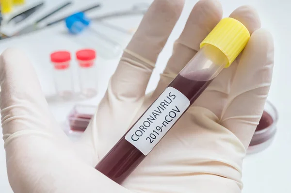 Hand of researcher holds test tube with blood for Coronavirus 20