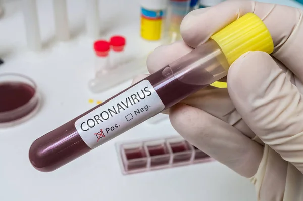 Tangan memegang tabung uji untuk analisis Coronavirus 2019-nCOV . — Stok Foto