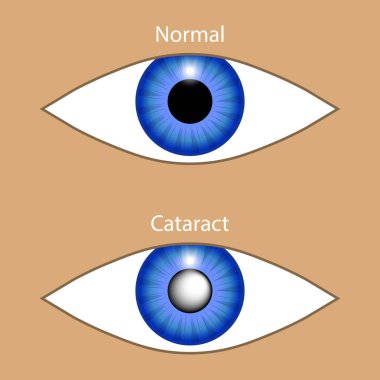 Kataraktlı ve normal bir göz. Sağlıklı ve hastalıklı optik organın vektör çizimi. Glokom hastalığında bulanık görme. Göz hastalıklarının teşhisi ve tedavisi için. Tıbbi broşür ve pankart konsepti.