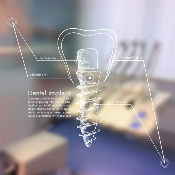 Ilustración vectorial. Fondo - Foto borrosa un dentista con un boceto - implantes dentales — Vector de stock