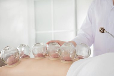  Terapist hastaya Cupping tedavisi uyguluyor