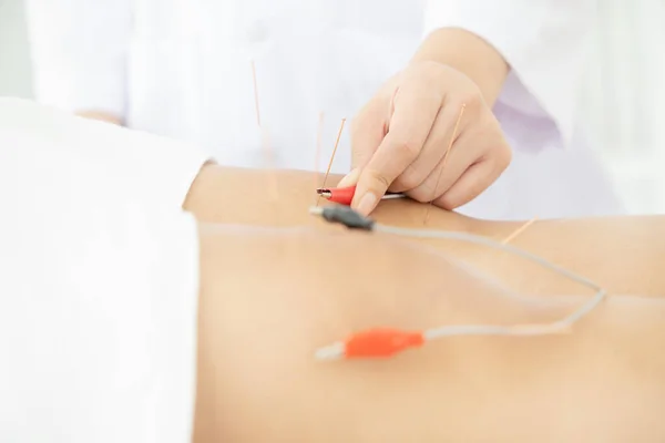 Traditionelle chinesische Akupunktur und Elektroakupunktur. — Stockfoto