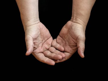 Siyah arkaplanda izole edilmiş nasırlı iki el.