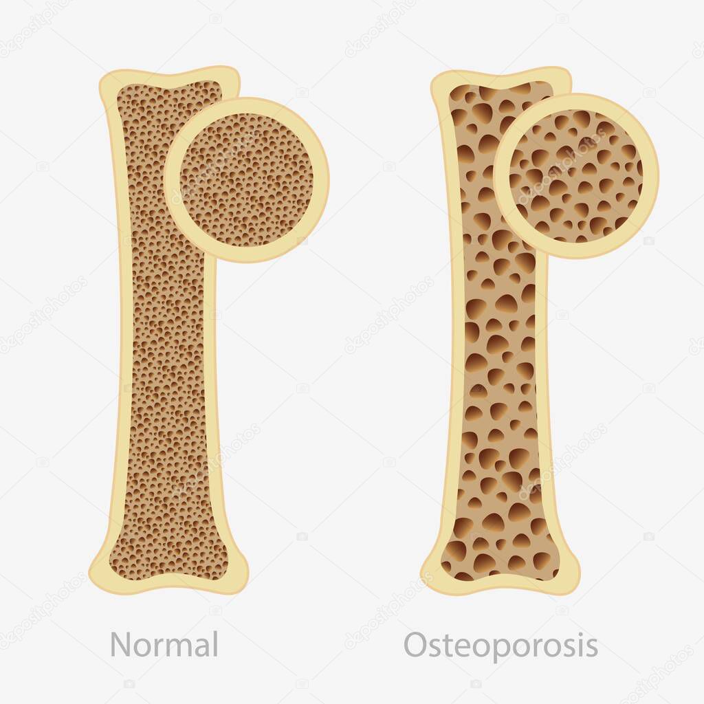 Cartoon human osteoporosis and normal healthy bone vector flat illustration