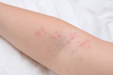 Kadın kolunda deri kızarıklığı alerjik reaksiyon, tepki, alerji ve dermatoloji konsepti sonucu kaşınan sivilceler.