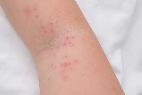 Kadın kolunda deri kızarıklığı alerjik reaksiyon, tepki, alerji ve dermatoloji konsepti sonucu kaşınan sivilceler.